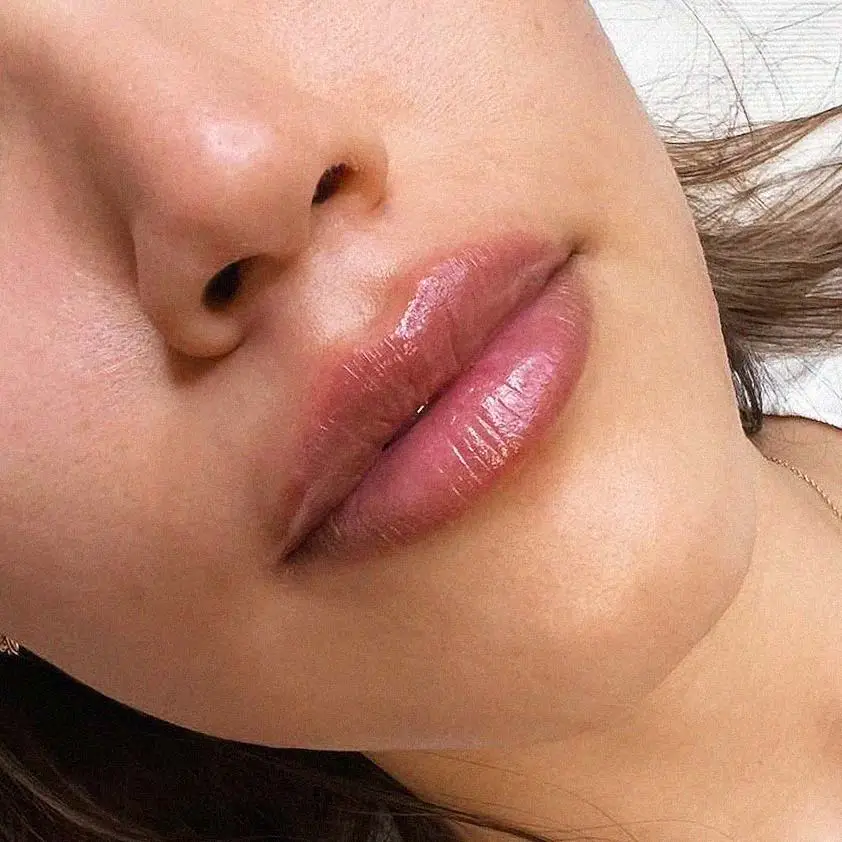 Ergebnis der Lippenunterspritzung bei Amara Berlin