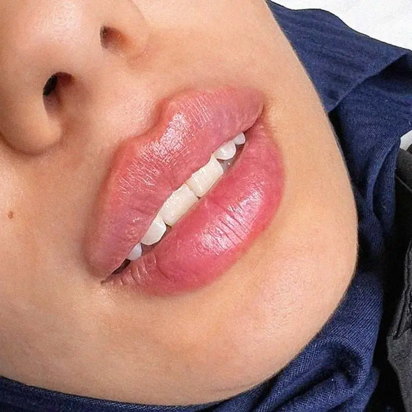 Ergebnis der Lippenunterspritzung bei Amara Berlin